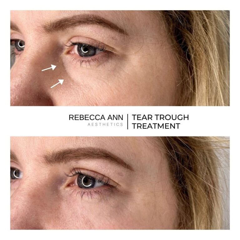 LIP FILLER BEFORE & AFTER-14