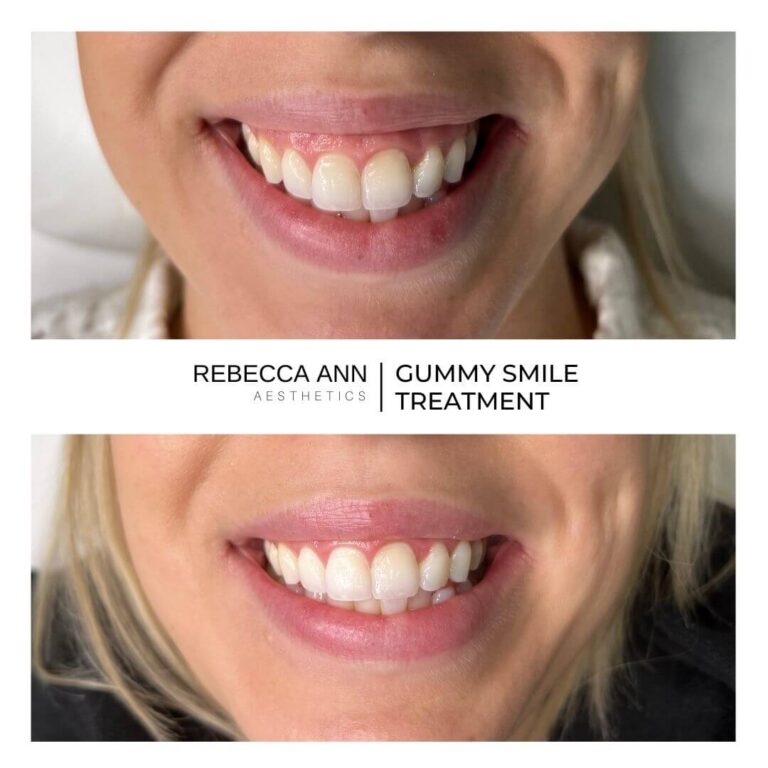 LIP FILLER BEFORE & AFTER-15 (1)