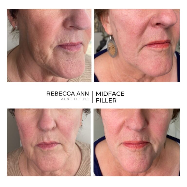 LIP FILLER BEFORE & AFTER-18