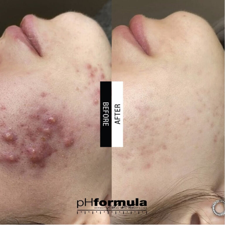 acne-resurfacing-treatments-04-case-study