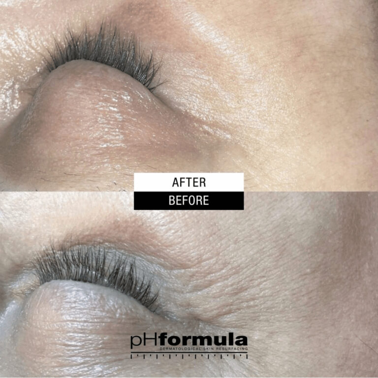 age-resurfacing-treatments-3-ampoules-01-case-study-2 (1)